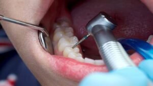 Root Canal Appreciation Day 2024: Investigate its Unique History and Facts